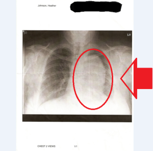 Chest X-ray of my cancer